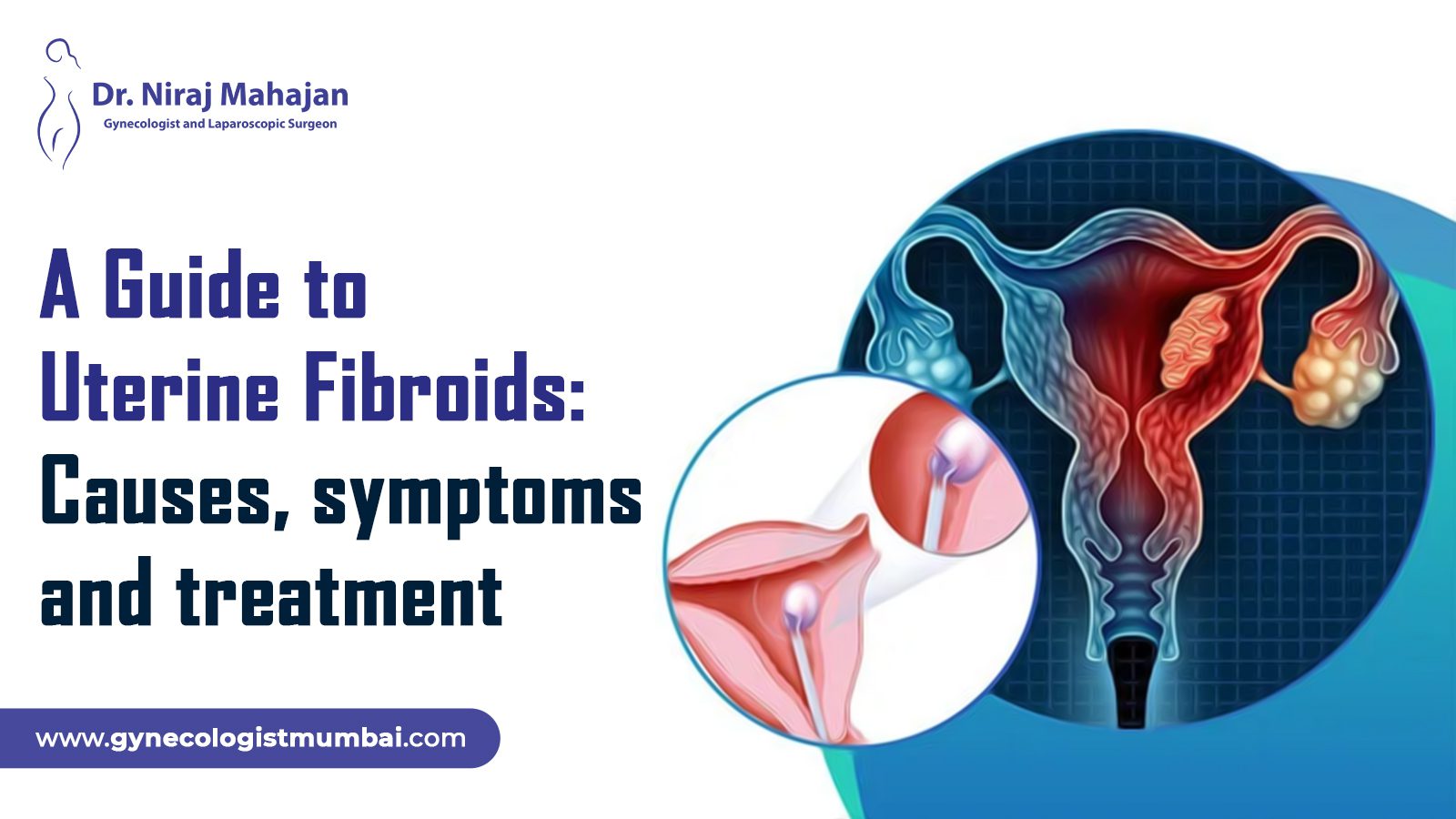 A Guide to Uterine Fibroids: Causes, symptoms and treatment
